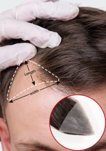 Temple Hair Patches Covering Bald hair Systems 1